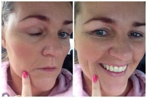 Restylane eller lade vær’