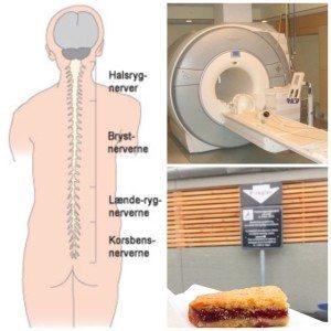 “Ups vi glemte at scanne din ryg” …